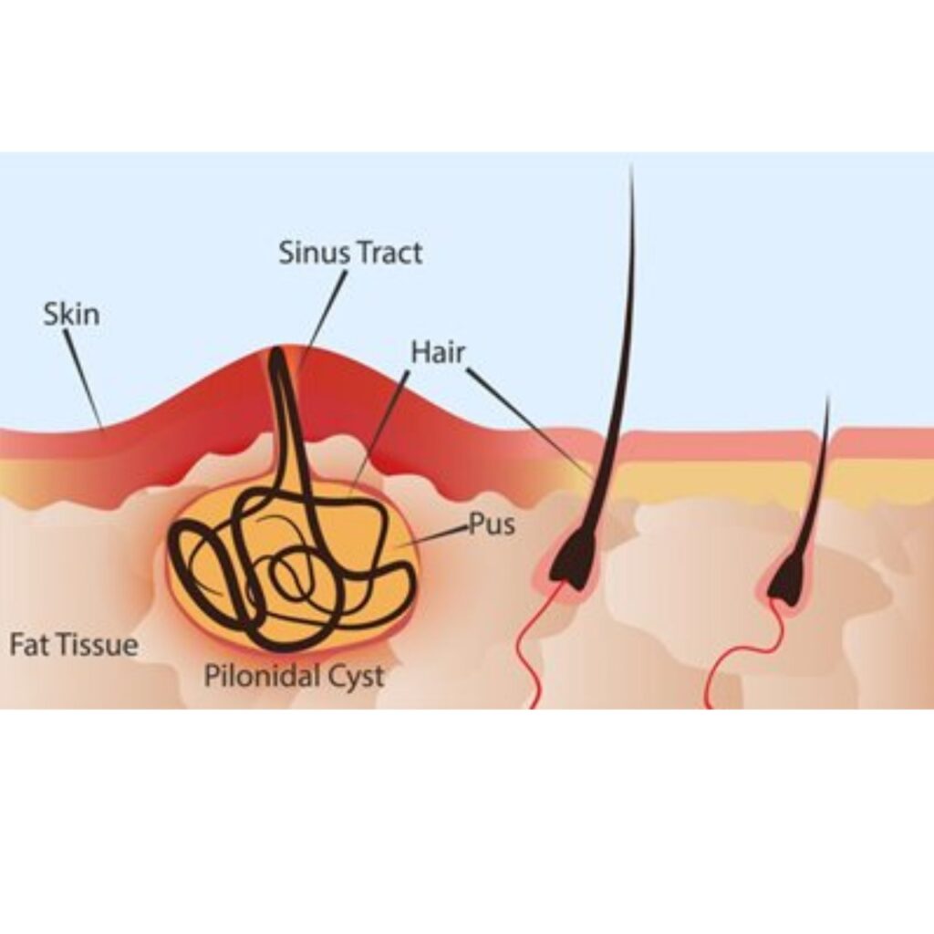 Pilonidal Sinus