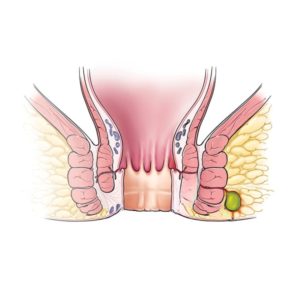 Fistula