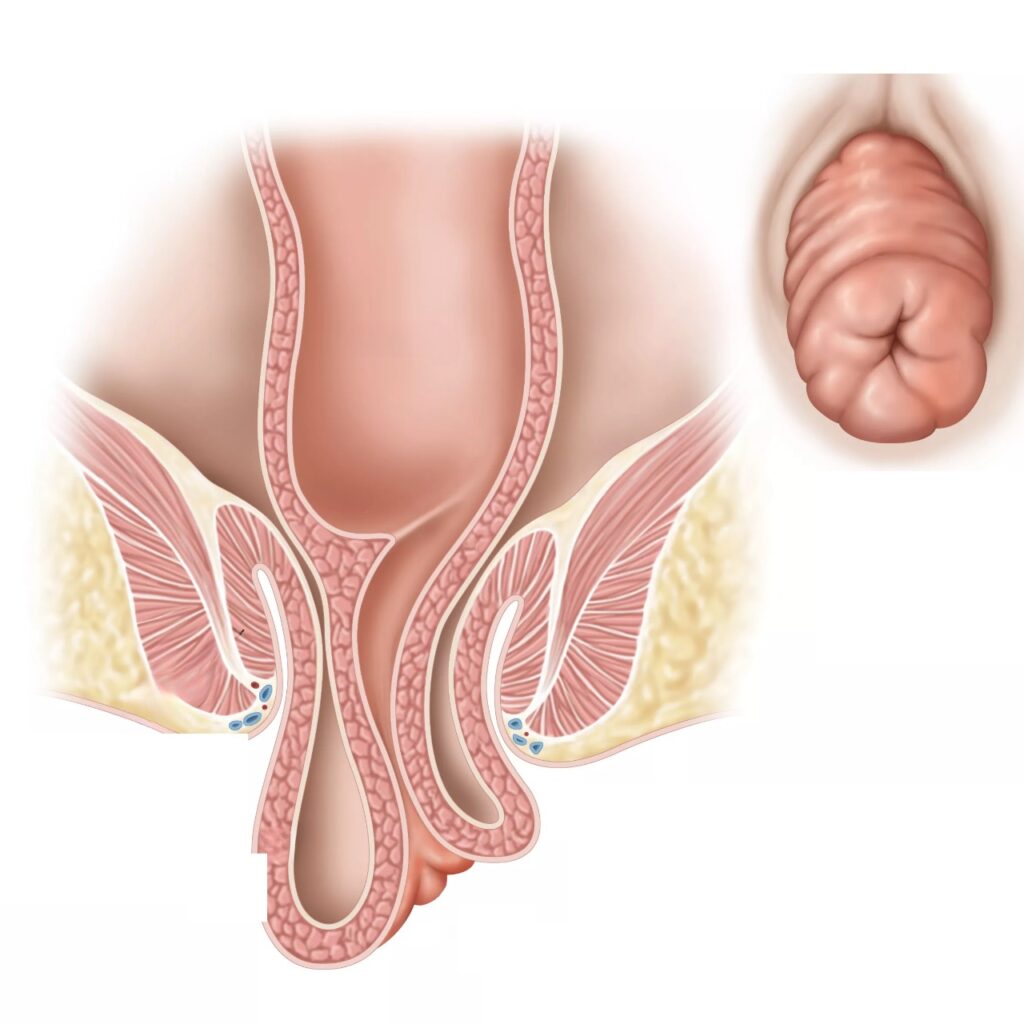 Rectal Prolapse