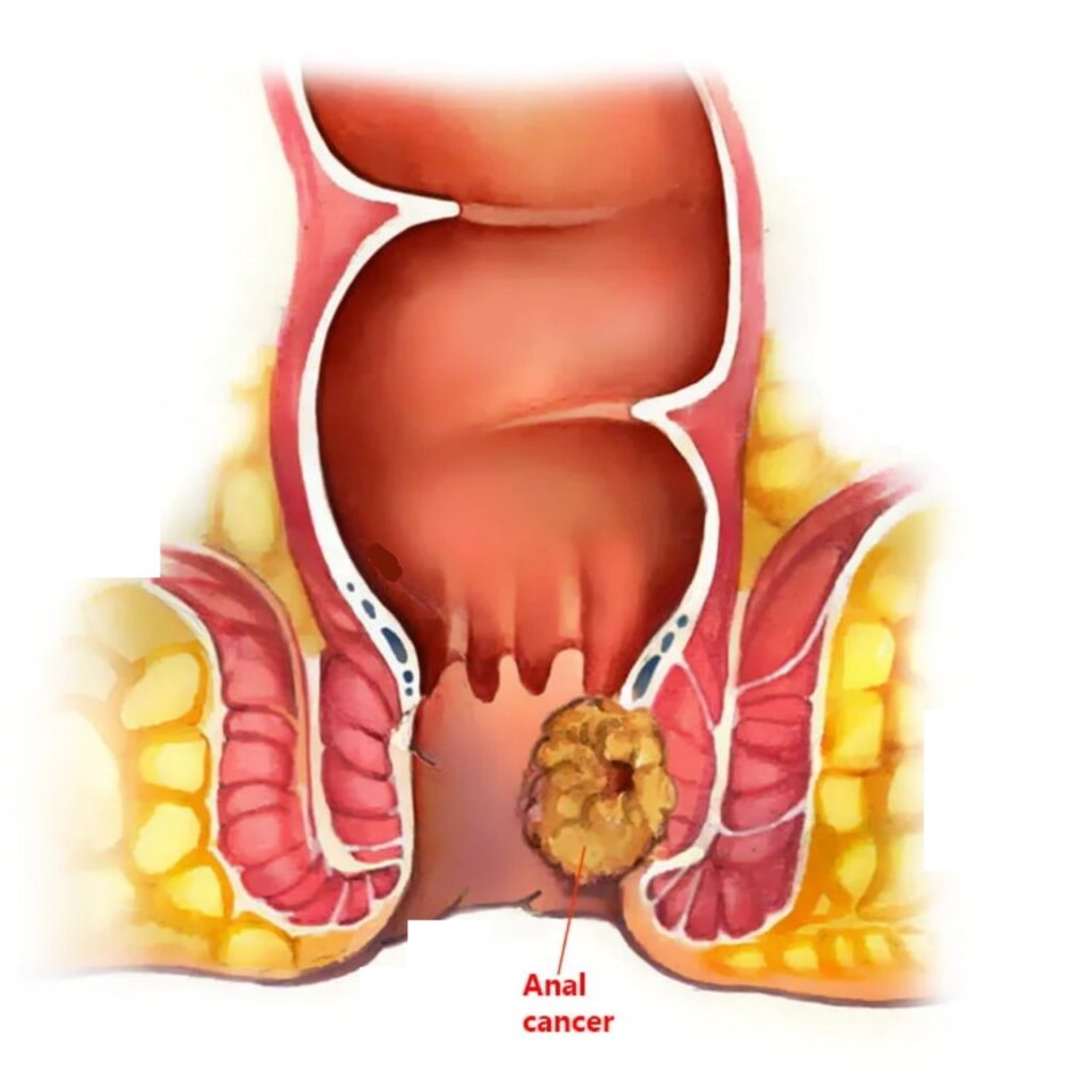 Anal Cancer