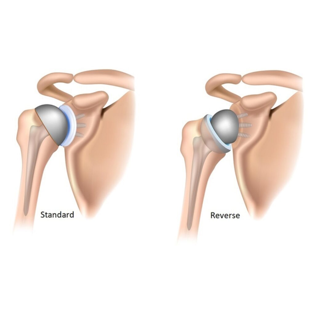 total shoulder arthroplasty