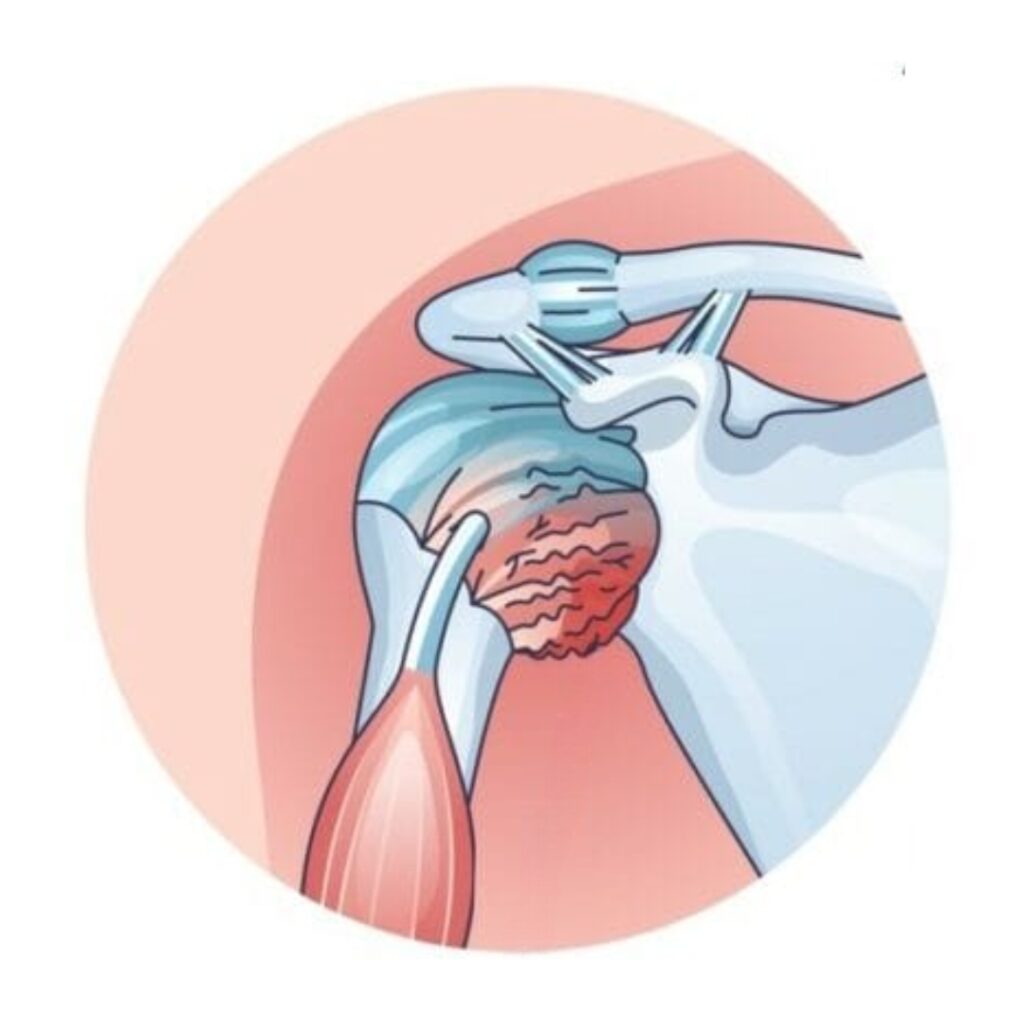 Frozen Shoulder
