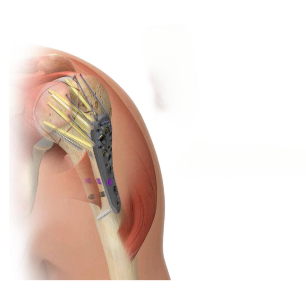 Shoulder fracture Reconstruction