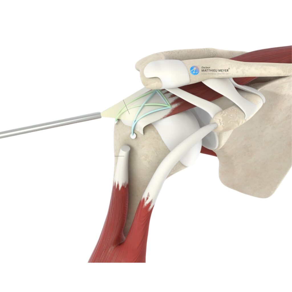 Arthroscopic Rotator Cuff Repair img