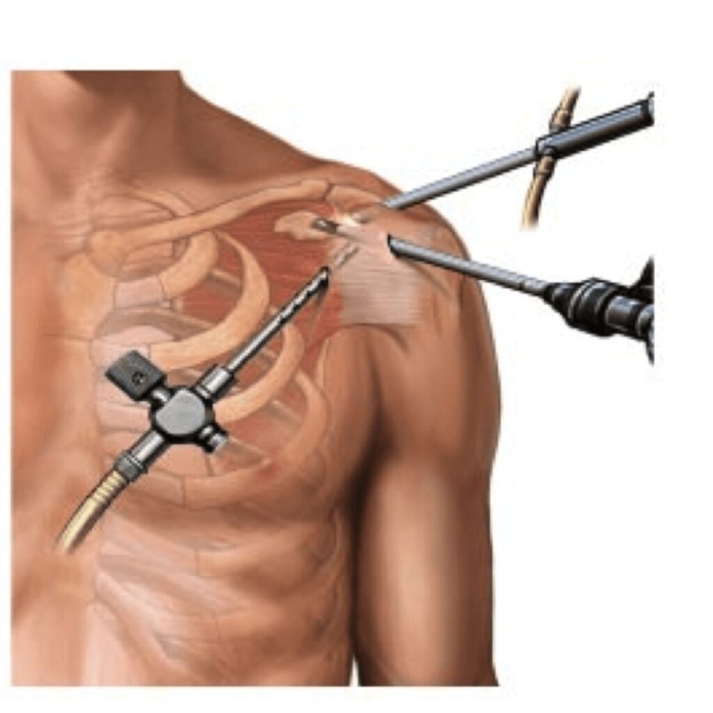 Shoulder Surgery