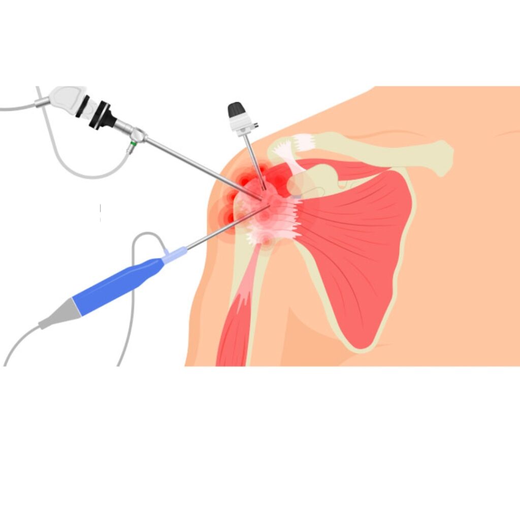 Arthroscopic Bankart Repair