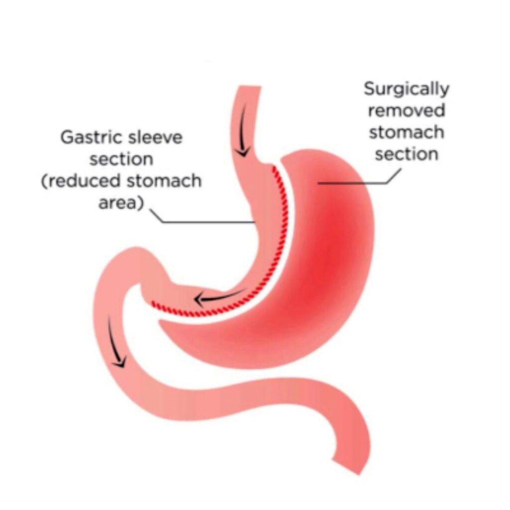 Sleeve Gastrectomy