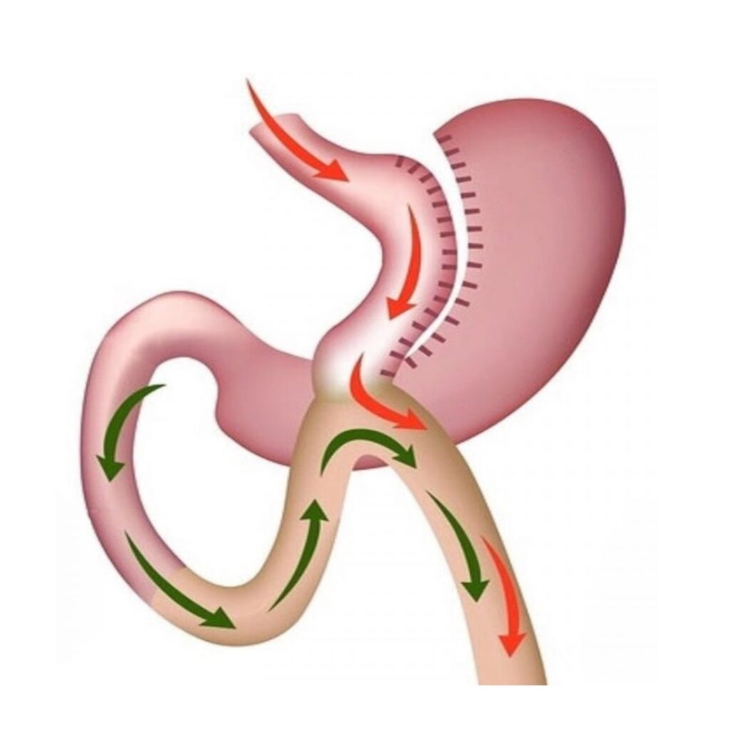 Mini Gastric Bypass (MGB)