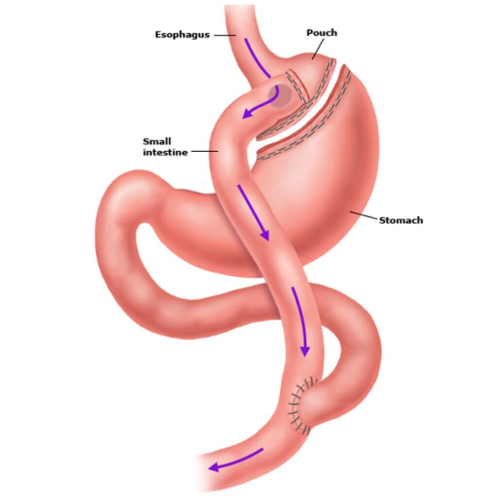Gastric Bypass Surgery