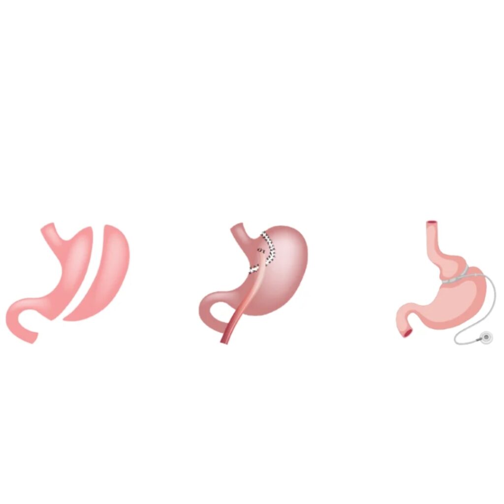 Revision Bariatric Surgery