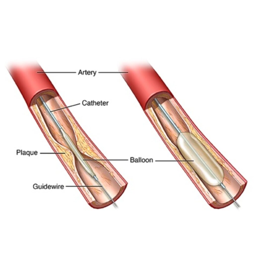 Angioplasty & Stenting