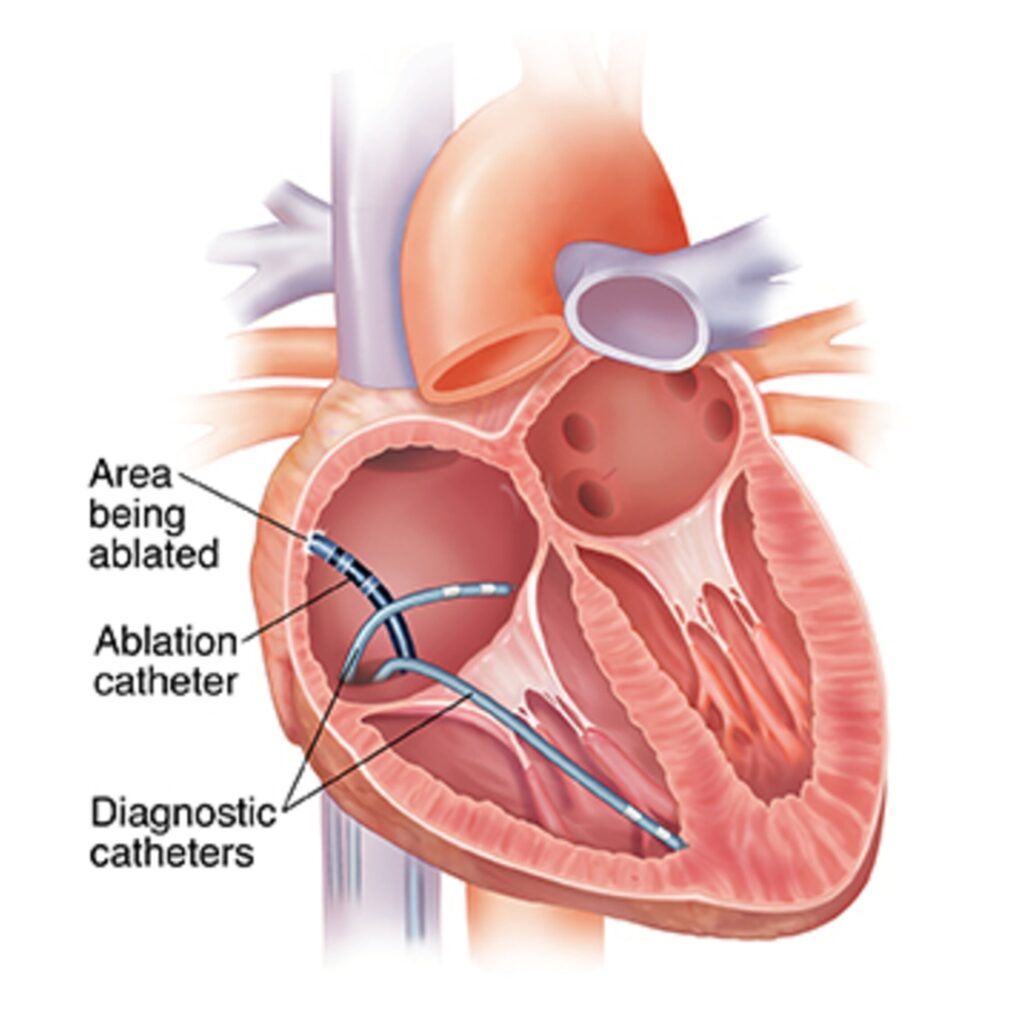Ablation Therapy