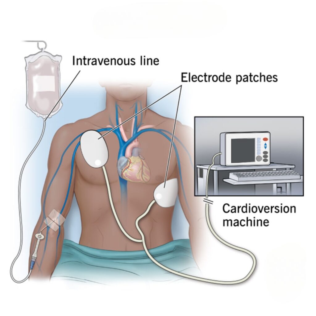 Cardioversion