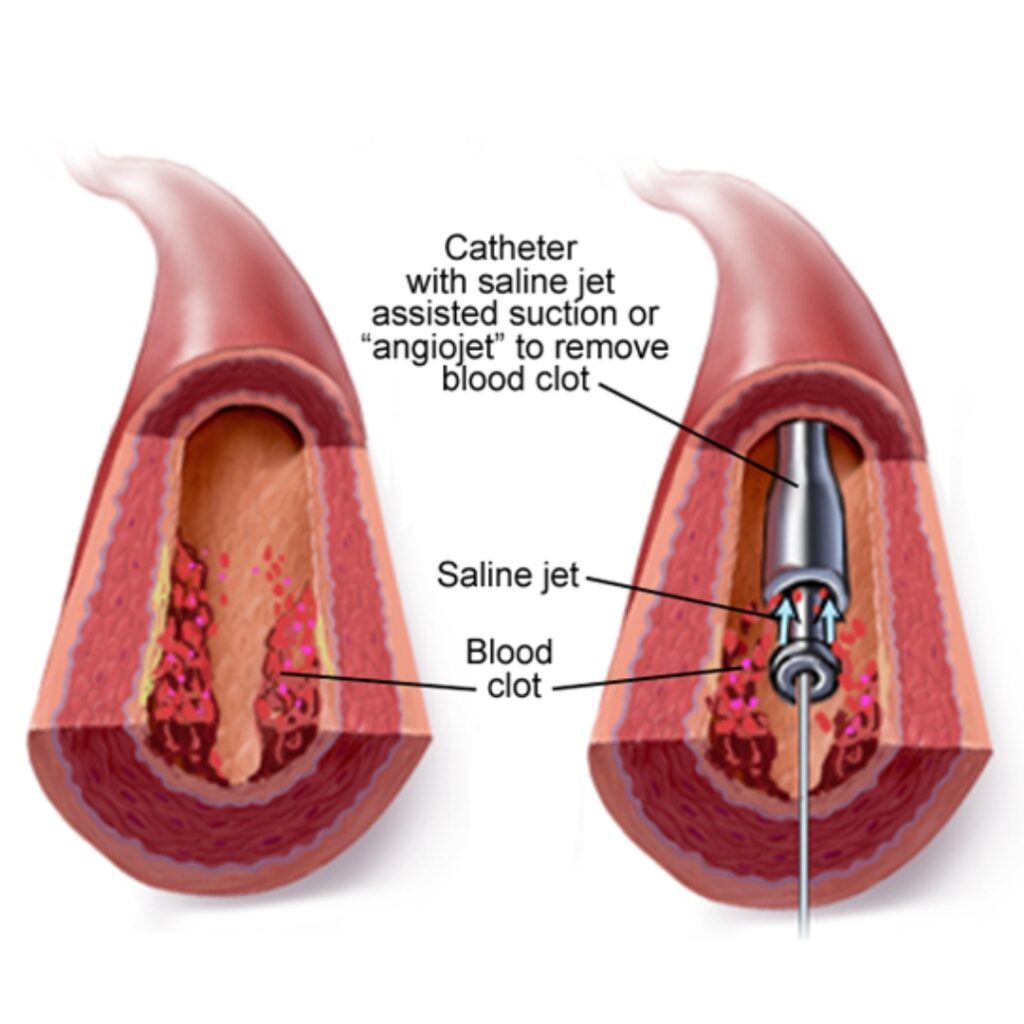 Thrombolysis