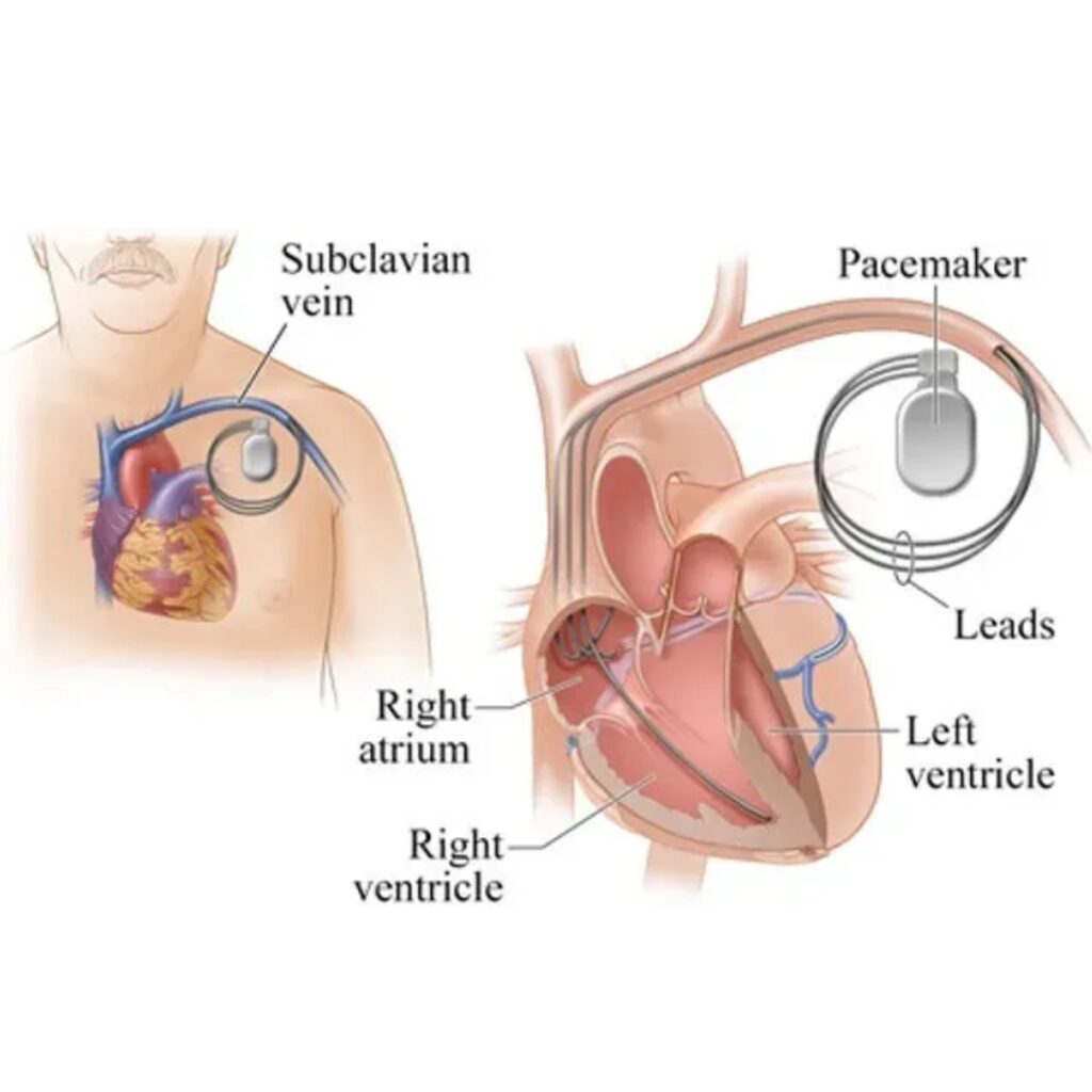 Pacemaker & ICD Implantation