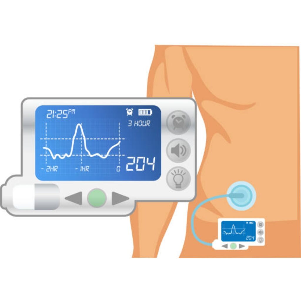 Insulin Pump Therapy