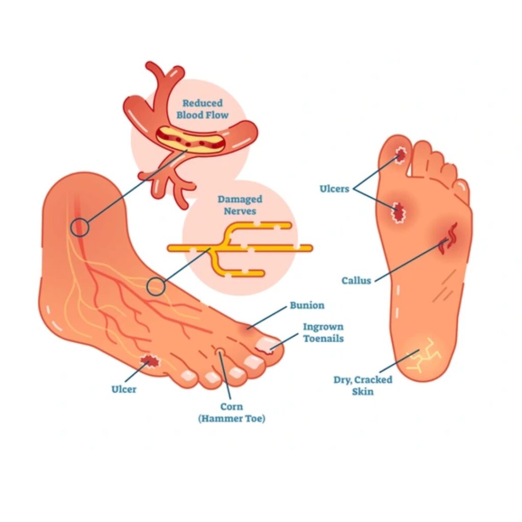 Diabetic Foot Care & Debridement