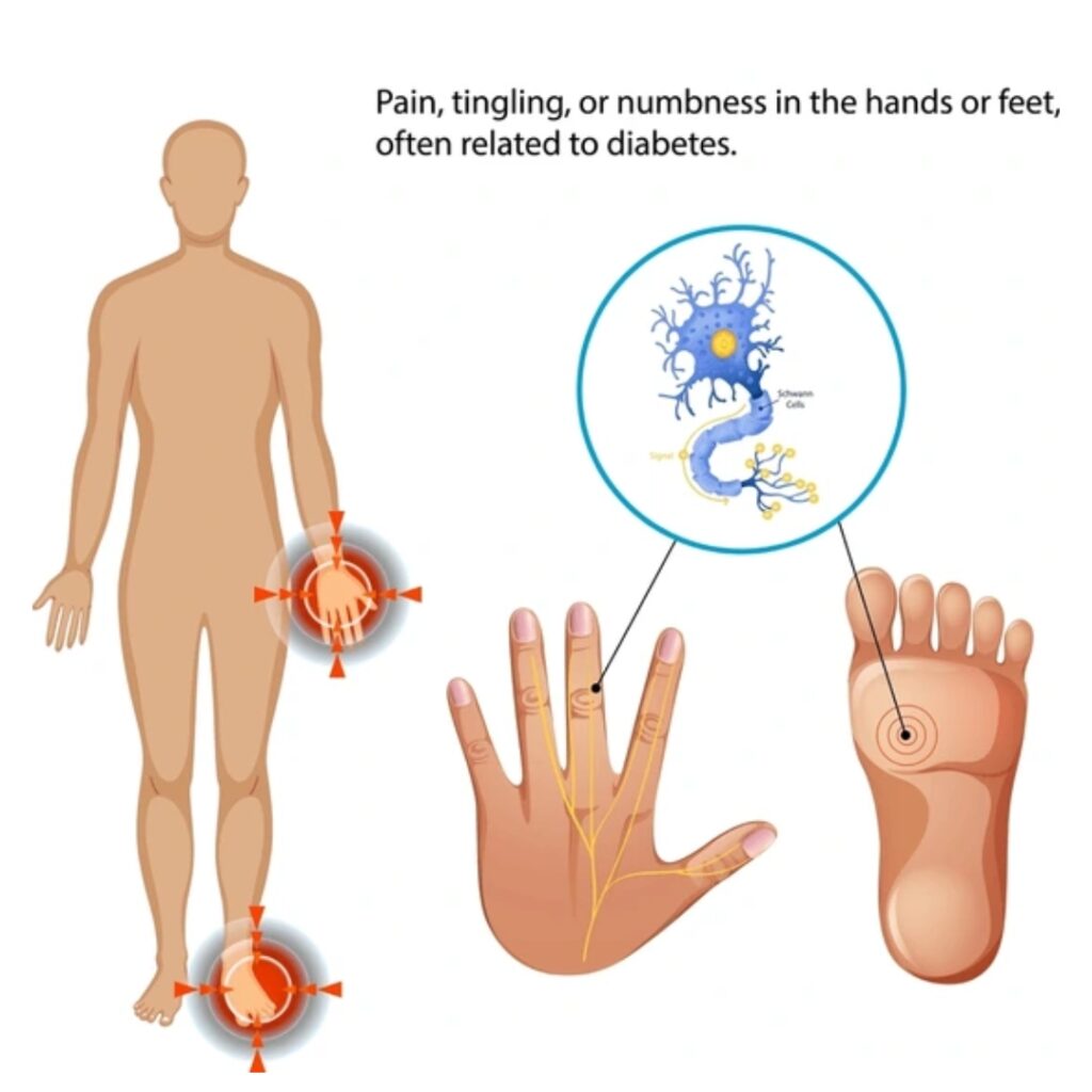 Diabetic Neuropathy Treatment