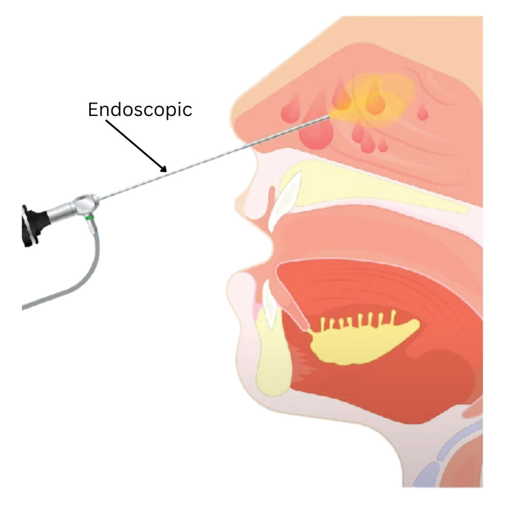 Endoscopic Sinus Surgery