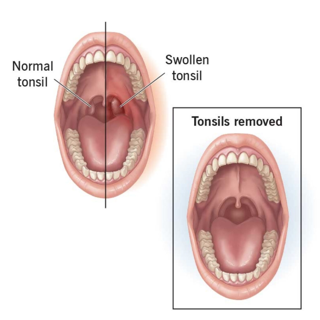 Tonsillectomy (Tonsil Removal Surgery)