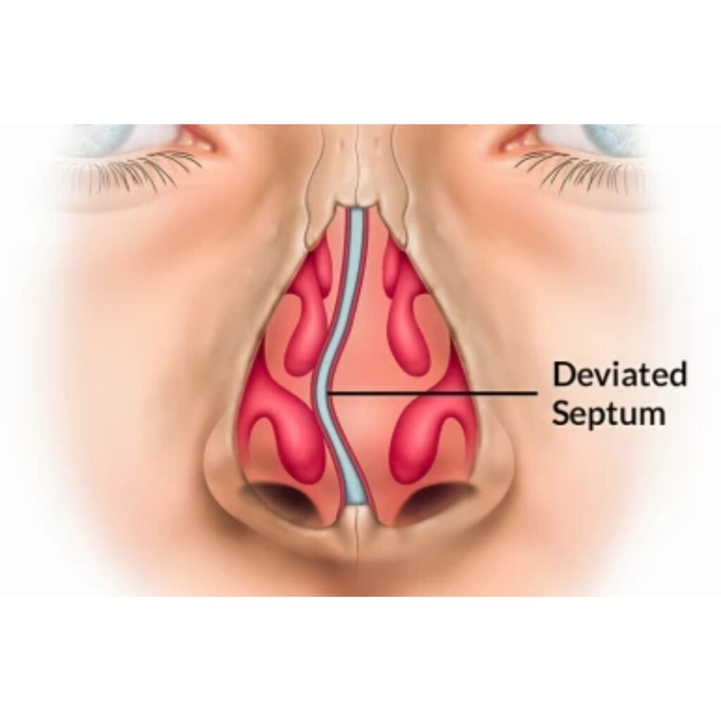 Septoplasty (Deviated Nasal Septum Correction)