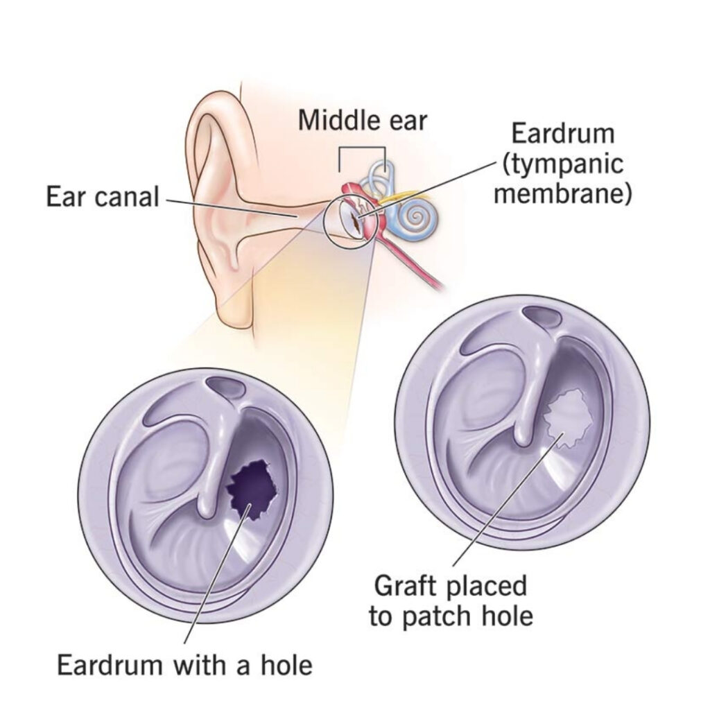 Tympanoplasty