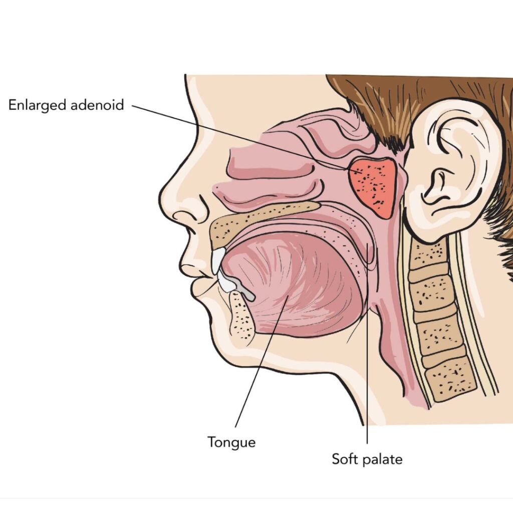 Adenoidectomy