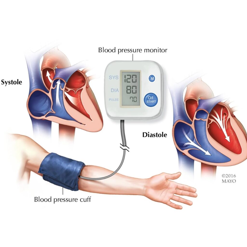 Hypertension (High Blood Pressure)