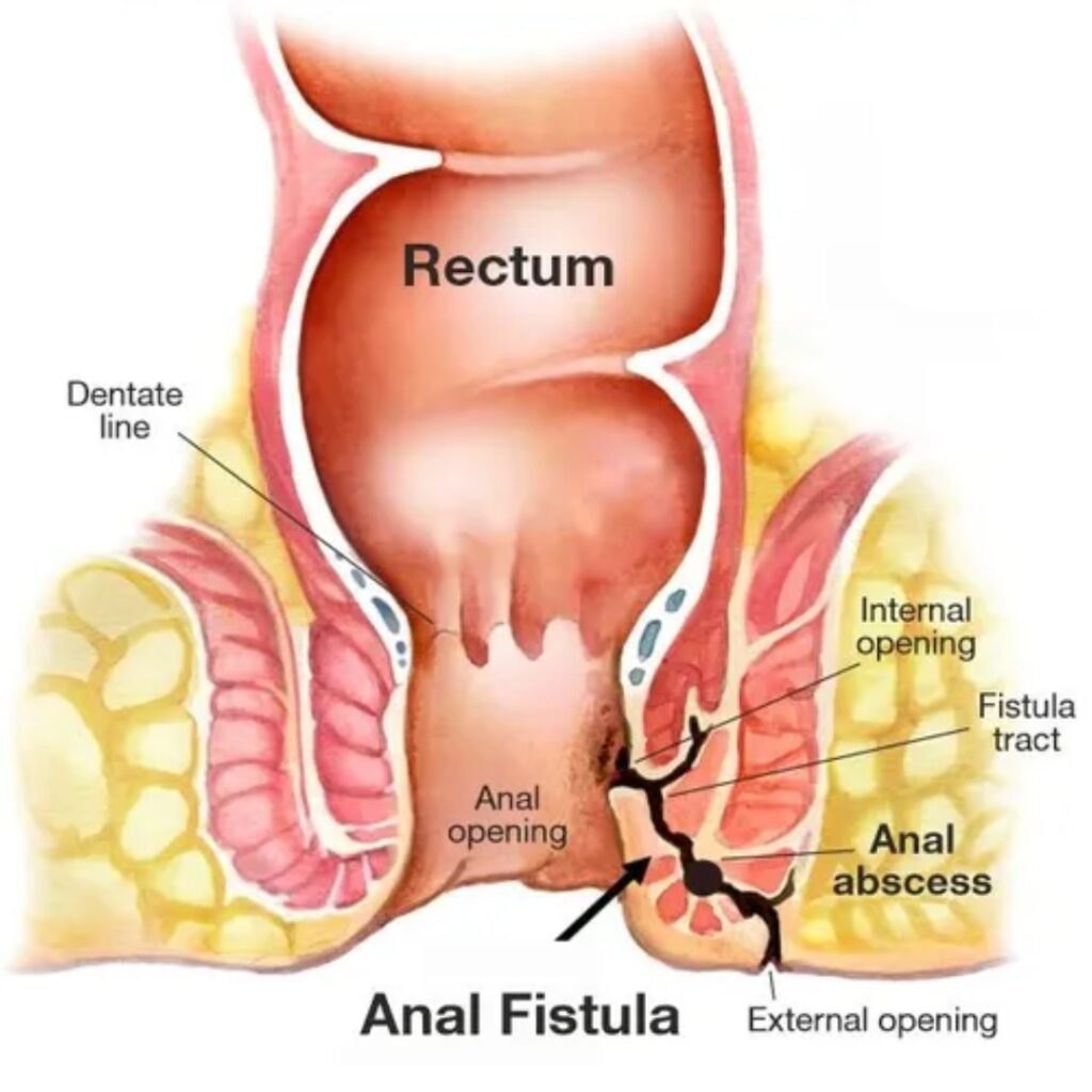 Fistula