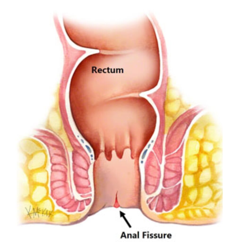 Fissure