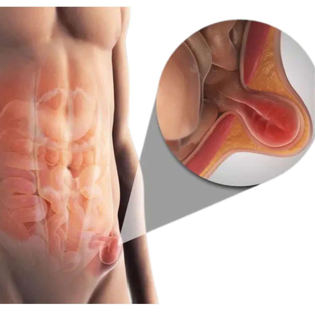 Hernia Repair