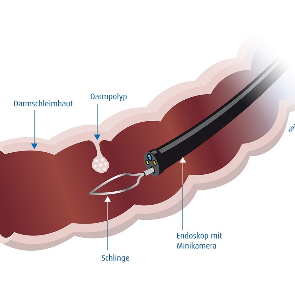Polypectomy