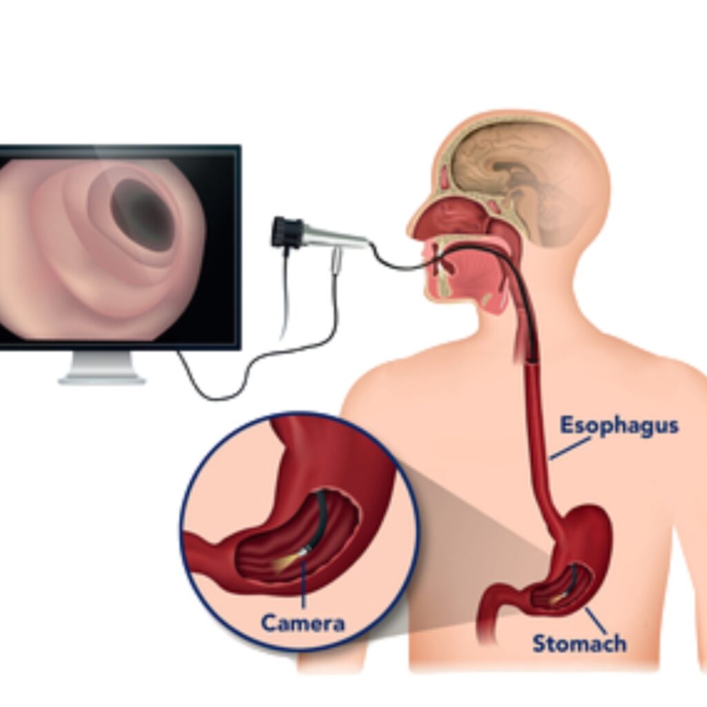 Endoscopy
