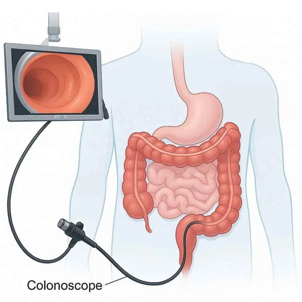 Colonoscopy