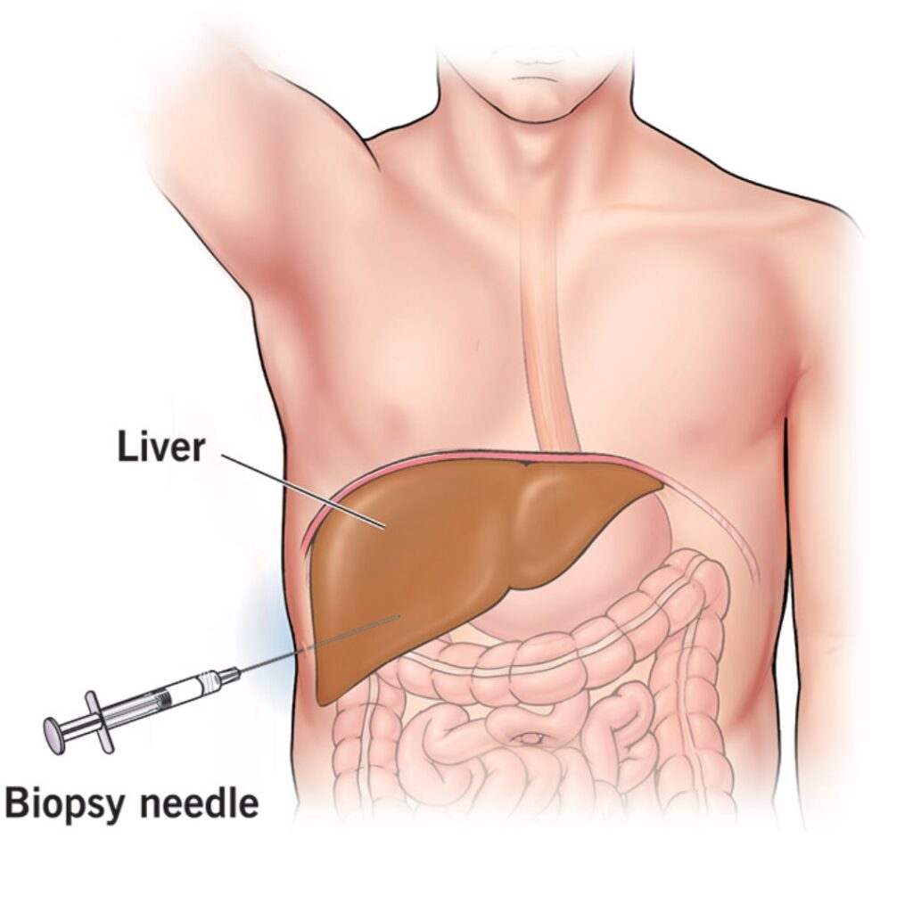 Liver Biopsy