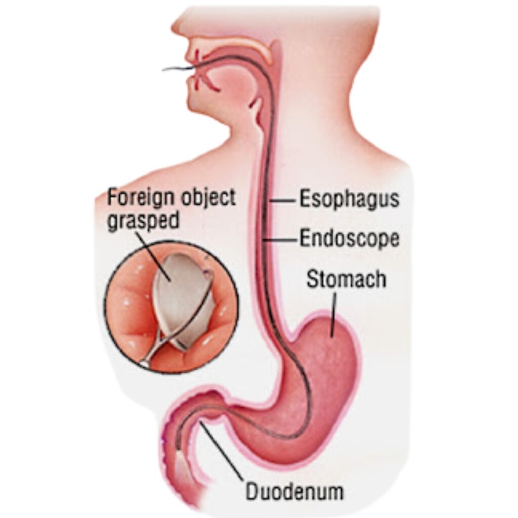 Foreign Body Removal