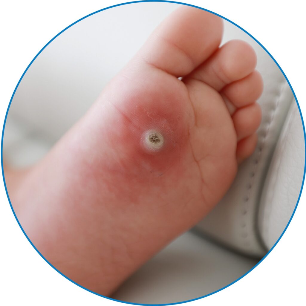 Diabetic Foot Ulcers at kkcare Hospital